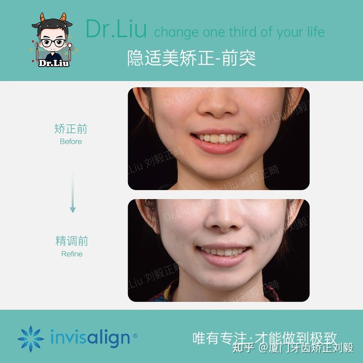 正畸临床拔牙矫治,拔牙正畸矫正嘴凸案例