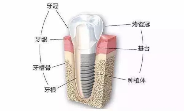 关于种植牙你需要了解这些,种植牙的过程分为几个步骤