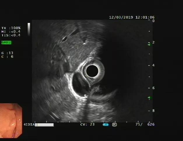 消化内镜发展现状,上消化道超声内镜临床应用