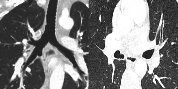 前上纵隔高密度影考虑胸腺未退化,肺纵隔胸腺结节12mm看什么科