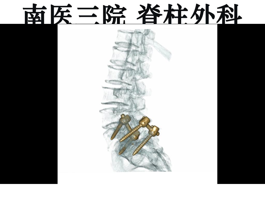 峡部裂导致的滑脱是不是必须手术,峡部裂保守治疗的方式有哪些