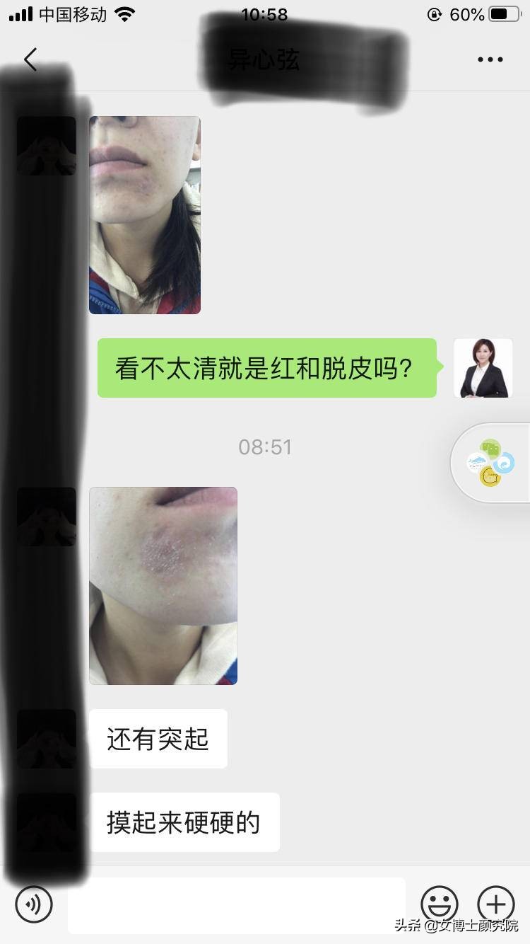 用了维a酸乳膏脸脱皮发红怎么办,刷酸脸红爆皮怎么办