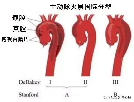 诊断主动脉夹层，千万别犯这种错误！
