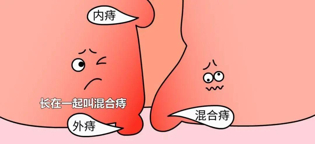 老年人肛门边有小疙瘩怎么治疗,老年人肛门掉出来最佳治疗方法