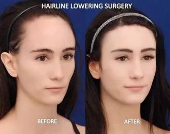 到什么程度适合植发,哪种植发创伤最小