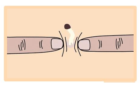 黑头多怎么办如何去除黑头,黑头贴去除顽固黑头