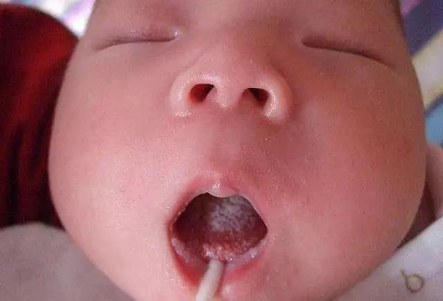 月嫂不懂护理鹅口疮,鹅口疮婴儿月嫂怎么护理