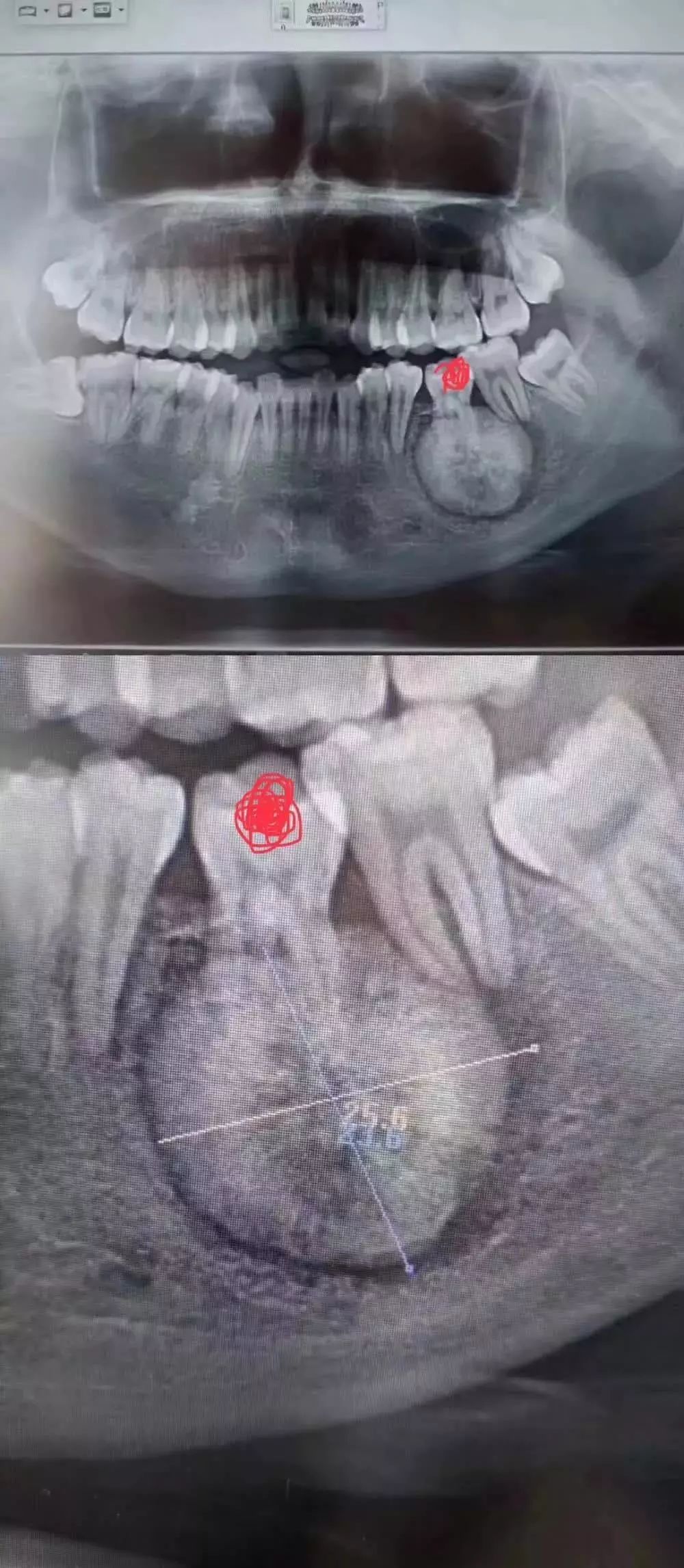 牙医警示看牙第一步为什么要拍片,牙医看牙片可以看出什么
