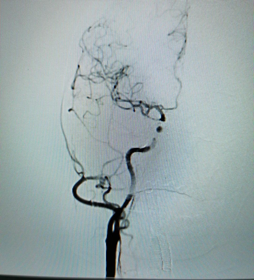 眼睛看东西重影是近视么,眼睛看东西重影是脑梗引起的吗