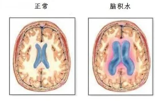 查出脑积水了要不要告诉家人,脑积水好治疗吗能彻底的治好吗