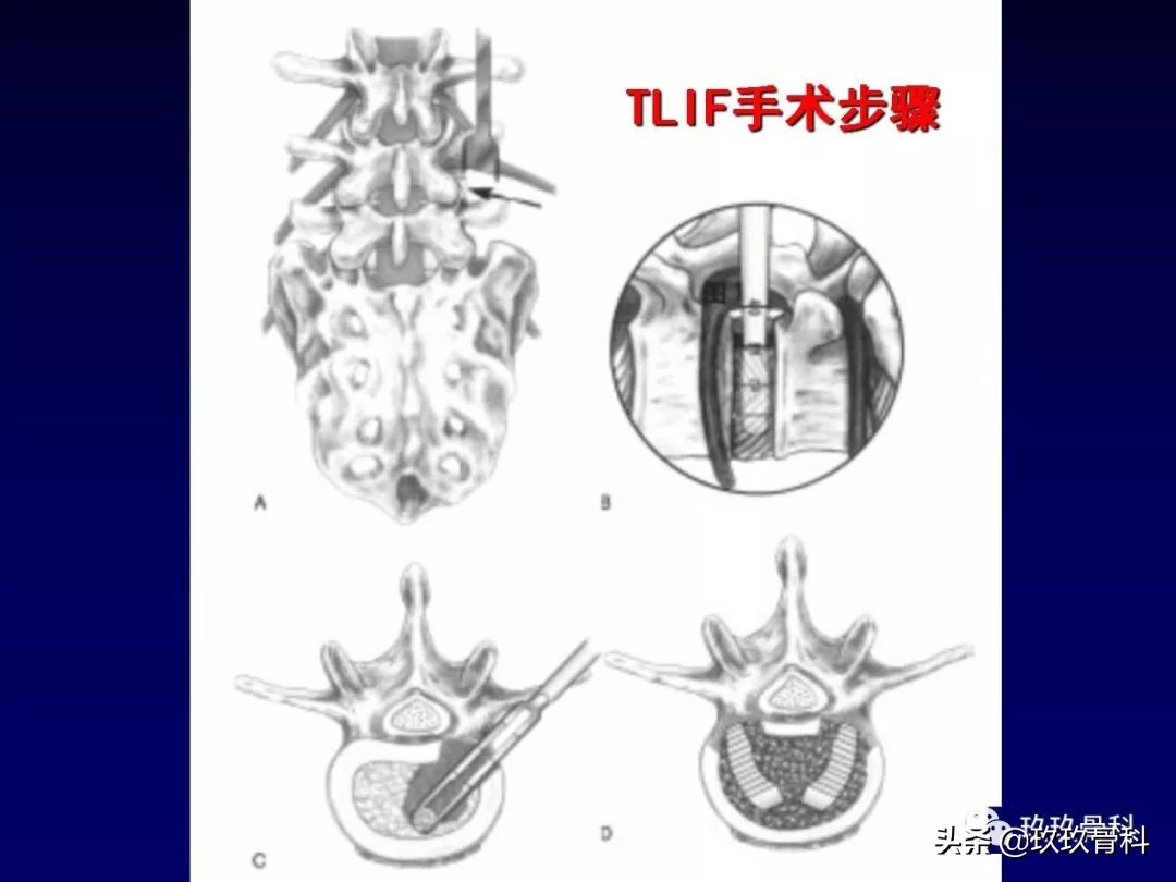 腰椎不稳最坏的结果,腰椎不稳的最佳治疗方法