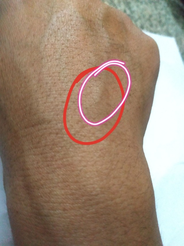 手受伤后，附近血管感觉有些堵塞，摸起来有个小包，这是怎么回事