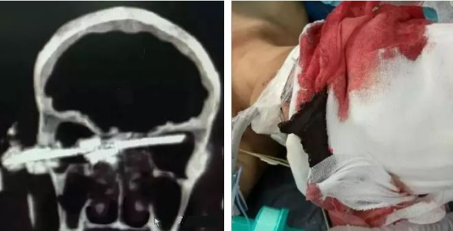 砂轮机会伤人吗,砂轮机伤人怎么防护