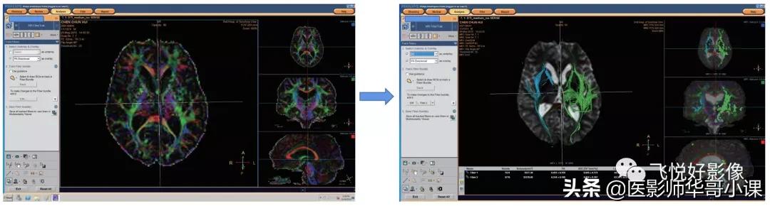 飞利浦磁共振波谱成像扫描技术,飞利浦磁共振纵隔扫描技术