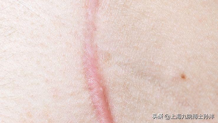 激光祛疤后疤痕变黑是什么原因,3厘米的疤痕激光祛疤手术多少钱