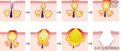脸上痘痘爆脓怎么处理,小孩脸上痘痘怎么处理