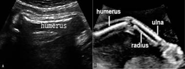 胎儿脊柱超声正常表现是怎样的,胎儿脊柱的超声诊断