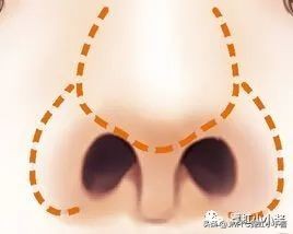 鼻子怎么修复好看呢,鼻型修复方法大全