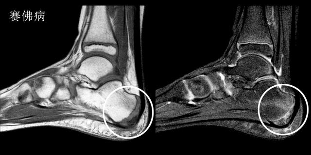 足跟疼痛教你一招百试百灵,早起落地脚疼