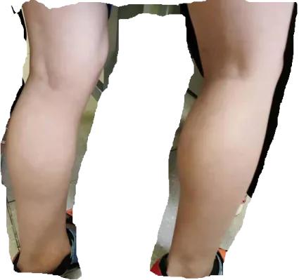 转氨酶升高是不是肝病啊,转氨酶升高听听肝病专家怎么说