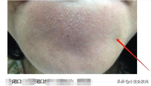 闭合性闭口怎么形成的,闭口怎么成痘痘了