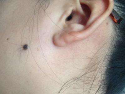 宝宝胎记的症状有哪些,宝宝出生有胎记是怎么来的