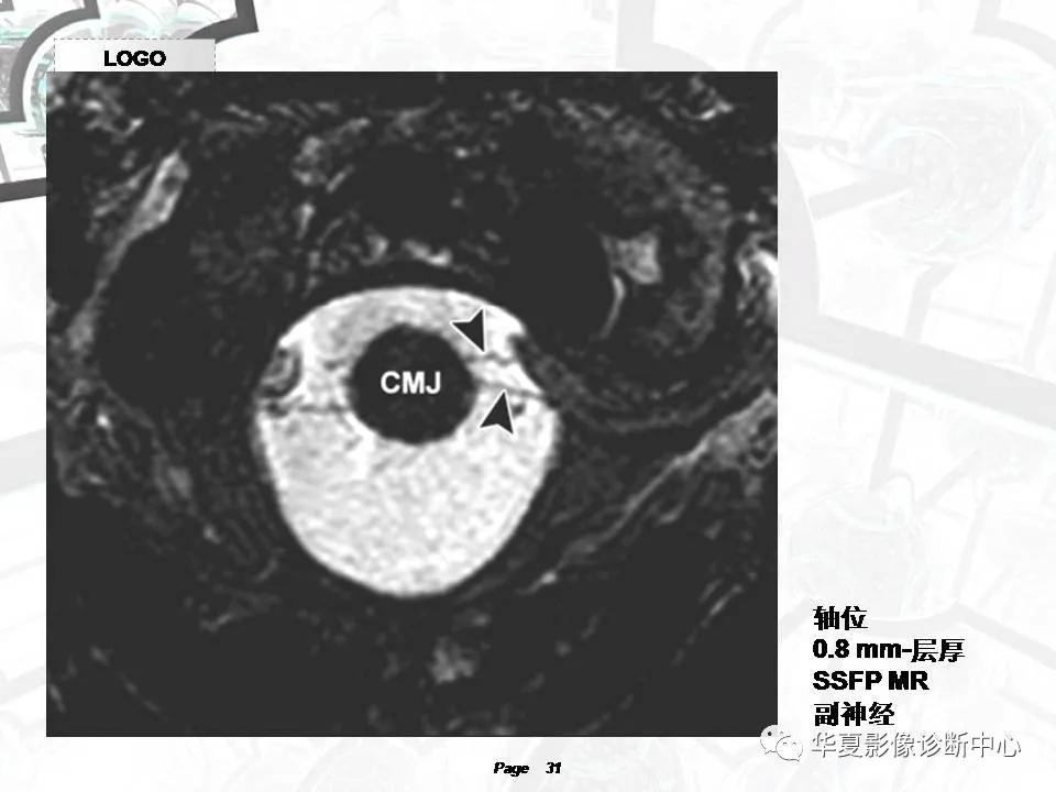 磁共振颅神经扫描是定位在哪,颅神经图谱