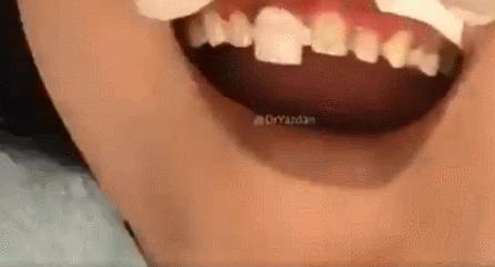 如果不满足种植牙条件缺牙怎么办,种植牙几百几千上万有什么区别