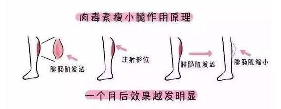 瘦腿针可以改善腿型么,瘦腿针成功的概率大吗