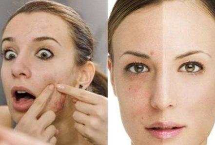 嘴下巴长痘快速消失的办法,36岁下巴长痘如何根治