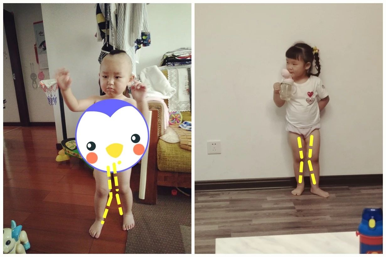 小孩喜欢勾腿是为什么,幼儿罗圈腿会自己好吗