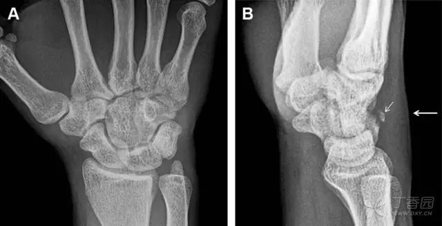 值夜班急救措施,放射科容易漏诊的骨折
