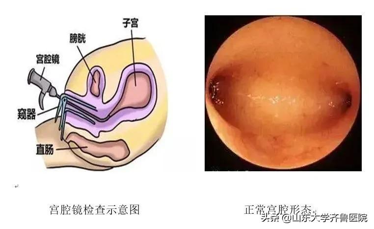 齐鲁医院做宫腔镜检查要多少钱,宫腔镜的科普知识