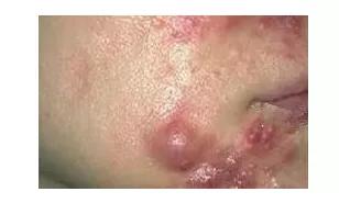 说说都如何治好痘痘的,一痘毁所有5个祛痘小技巧