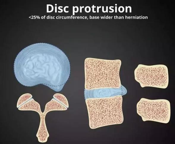 腰椎间盘的膨出和突出有什么区别,腰椎间盘突出膨出骨质增生怎么治