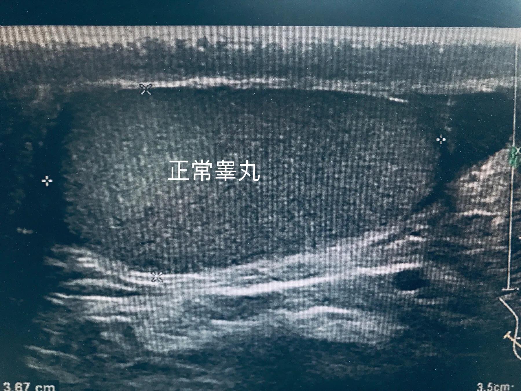 睾丸发生什么样的变化会影响生育,两侧睾丸都碎裂影响生育吗