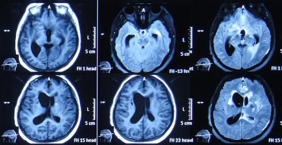 结核性脑积水,脑膜炎脑积水要治疗多久