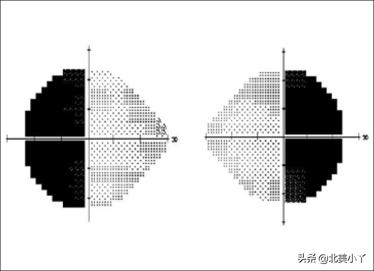 小丫说医｜一类影响全身的特殊脑瘤——“尽管罕见，但不能忽视”