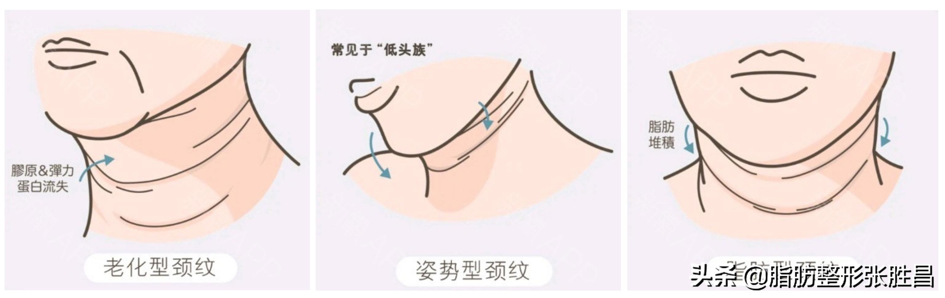 颈纹太多又显老，但常规方法祛除总是不能持久？做这个就可以了