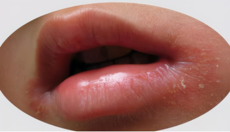 嘴角开裂流黄水结痂是什么感染,嘴角干裂有黄色结痂