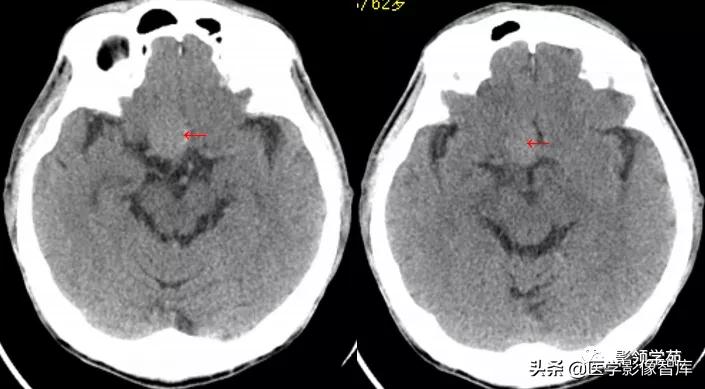 鞍区肿瘤做什么检查得出来,鞍区肿瘤的影像学鉴别