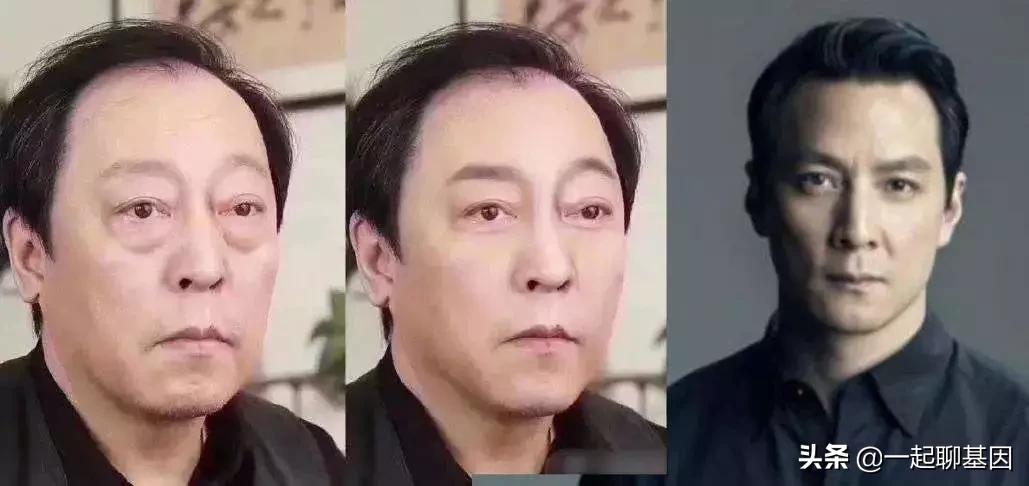 大眼袋眼纹抹平了,眼纹医美怎么去除