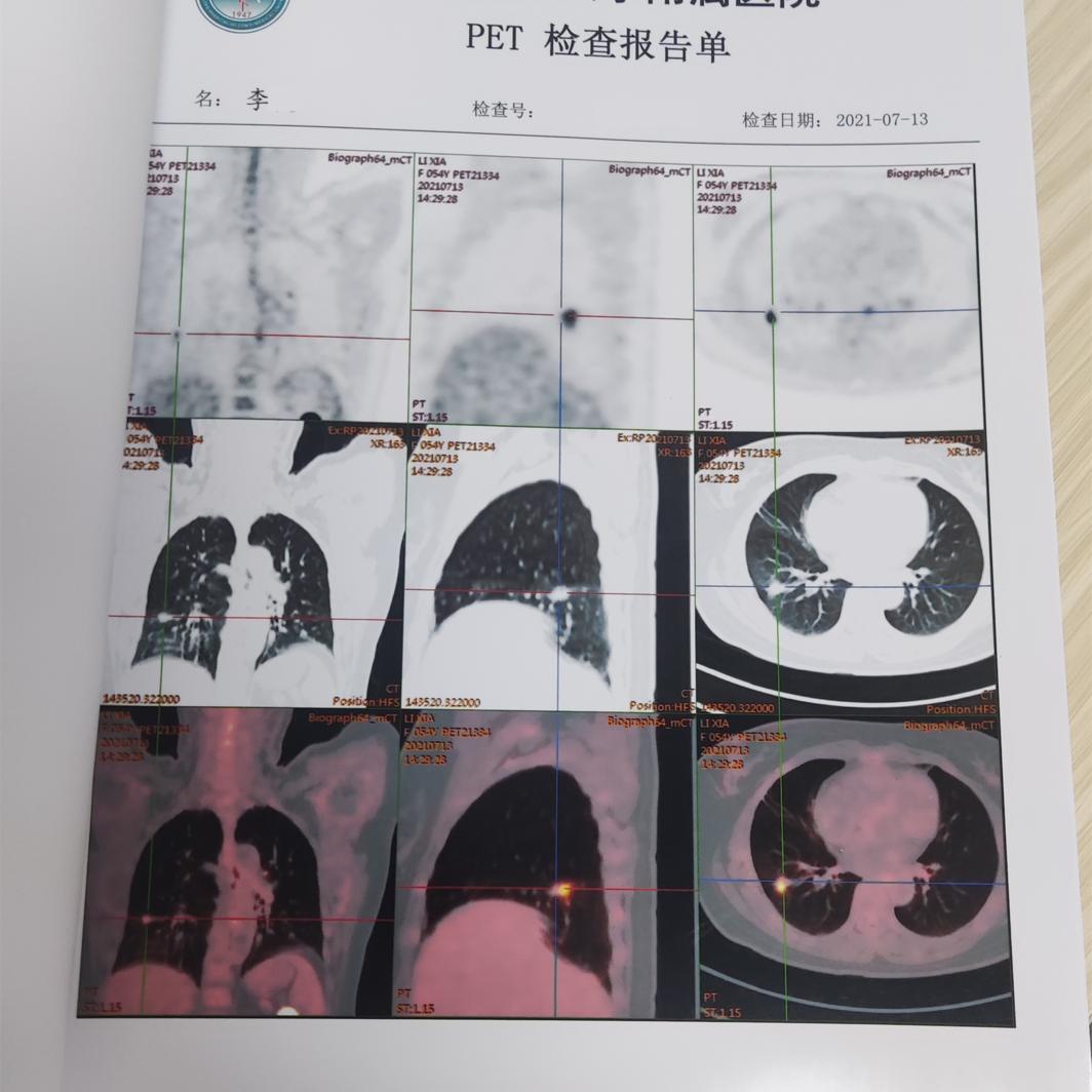 免疫治疗靶向治疗肺癌晚期,免疫疗法治疗晚期肺癌费用