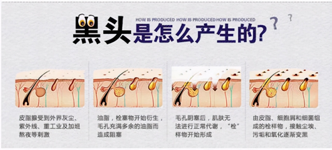 激光祛黑头真的可以去除吗,激光治疗黑头毛孔粗大多少钱