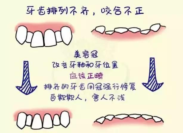 前牙磕掉了一块怎么办?#葉子口腔科普#