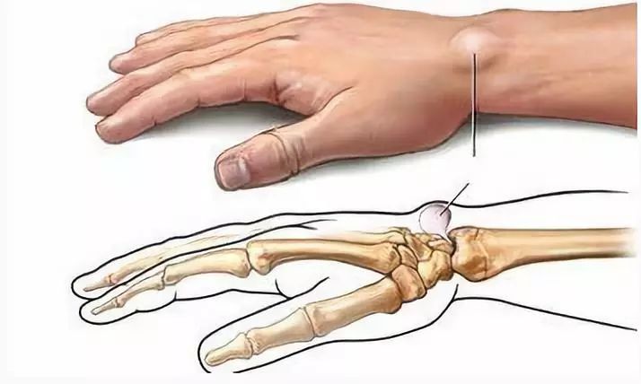 手腕出现小疙瘩越来越大,手腕突然长了一个小骨