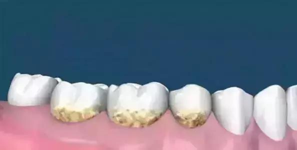 一口黄牙竟让形象尽毁！‘到手香’帮你重新找回自信！大胆开笑