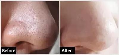 果酸可以根治闭口吗,果酸去闭口可以天天用吗