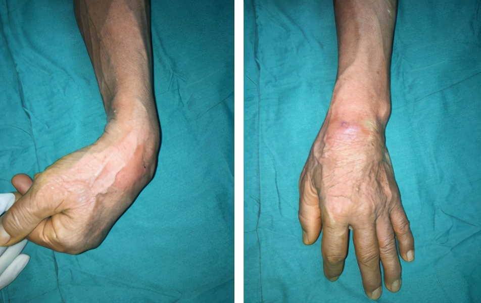 老汉长鸽子蛋大的结石,79岁老人左手腕长鸽子蛋