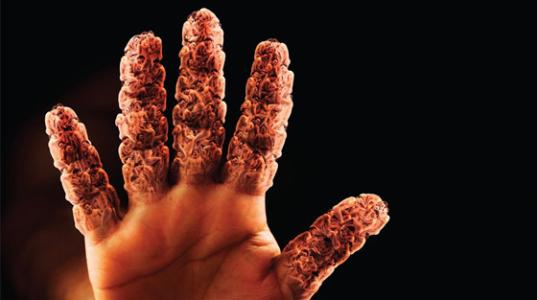 关节炎可以通过打抗生素治疗吗,关节炎治疗的注意事项